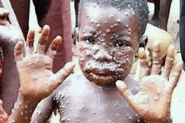 Monkeypox-Hits-Sinoe-Health-Team-Confirms-Several-Suspected-Cases