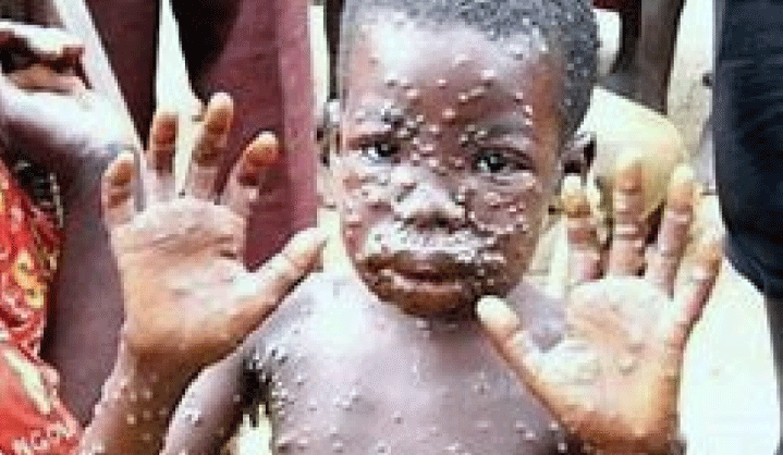 Monkeypox-Hits-Sinoe-Health-Team-Confirms-Several-Suspected-Cases