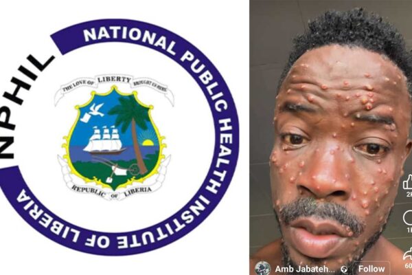 Looming Public Health Threat!…Four Active Monkey Pox Cases Reported Infected-MPox-Victim,-Comedian-Jabateh-MPox-virus-in-Liberia