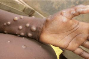 Monkeypox-virus-outbreak-in-Liberia