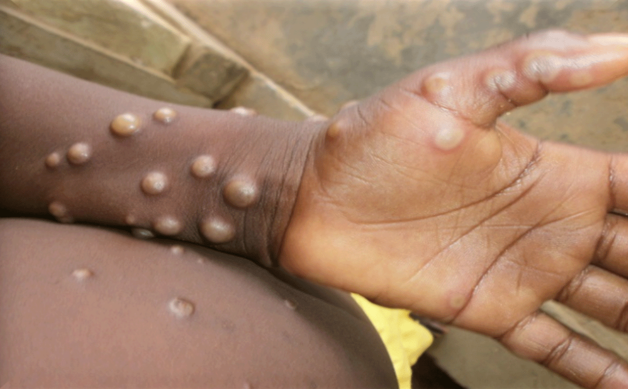 Monkeypox-virus-outbreak-in-Liberia