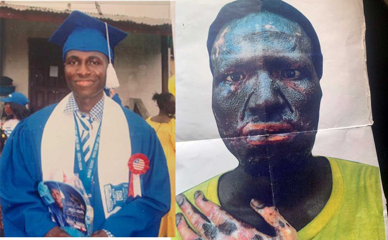 Sekou-Jabateh-a-victim-of-the-Mira-Gas-explosion